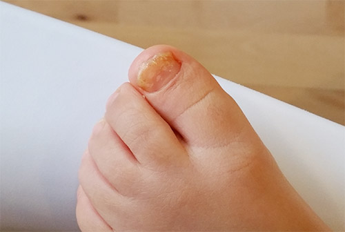 Cum se tratează micoza între degete, Ciuperca piciorului – tratament si prevenirea recidivei